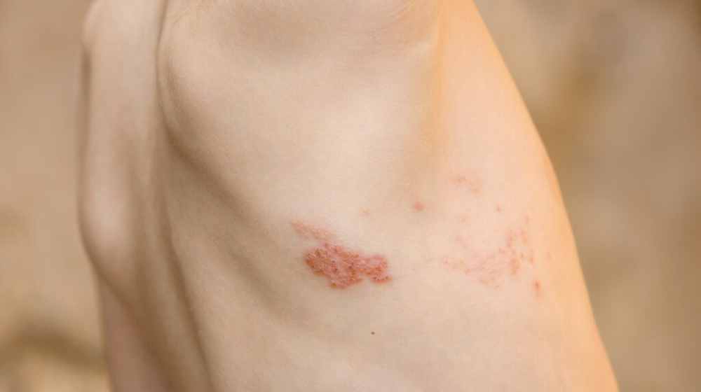 impetigonahrbtu.jpg